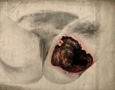 Severely diseased tissue on the thigh and buttock of a woman