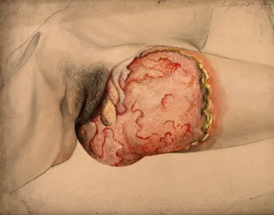 Severely diseased tissue on the thigh, buttock and genital area of a woman