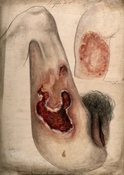 Severely diseased tissue on the thigh of a woman, with scar tissue shown on her upper arm