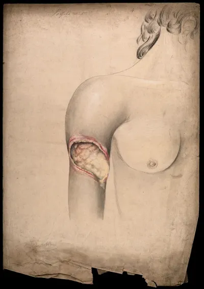 Severely diseased tissue on the upper arm of a woman