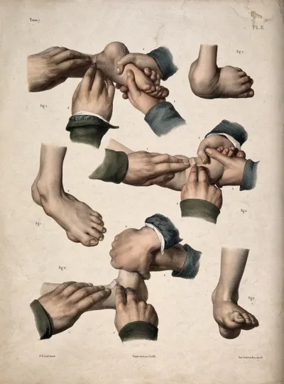 Six diagrams illustrating various clubfeet and operations demonstrating how to cure them