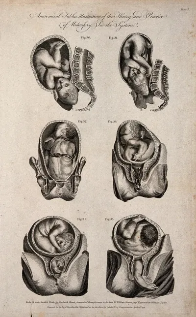 Six diagrams of babies in different delivery positions in the womb
