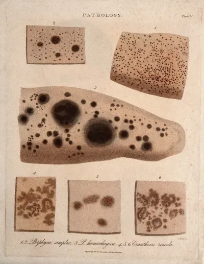 Six patches of skin showing types of skin disease