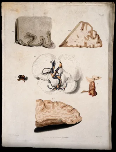 Six sections of diseased brain
