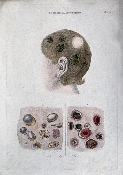 Skin diseases: a child's head with symptoms of favus; bottom left, pemphigus; bottom right, scabs on sores