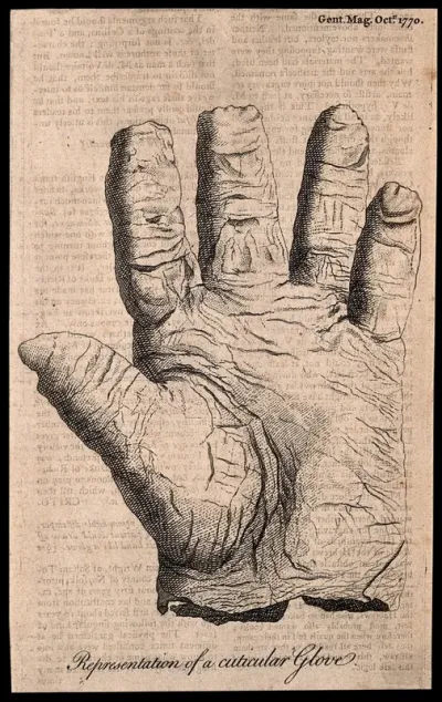 Skin of the hand peeled off like a glove as a result of a skin disease