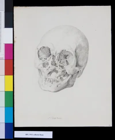 Skull, frontal view, fracture