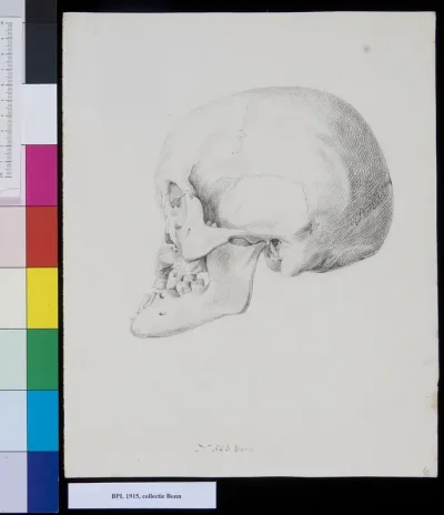 Skull, lateral view, fracture