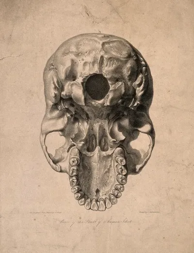 Skull of 'a human idiot' seen from below