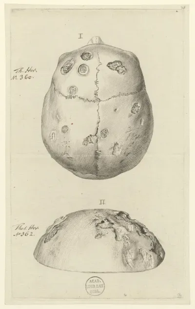 Skull: Pathology, fractures