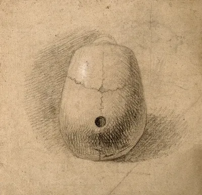 Skull, seen from above: Hole in sagittal suture