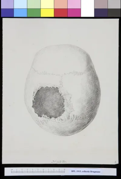 Skull with hole in the parietal bone