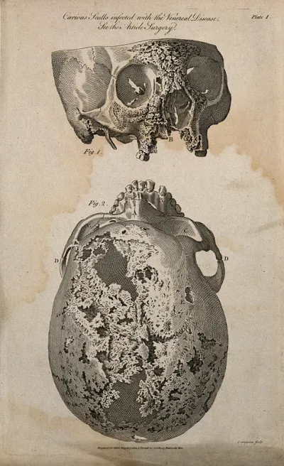 Skulls infected with venereal disease: two figures