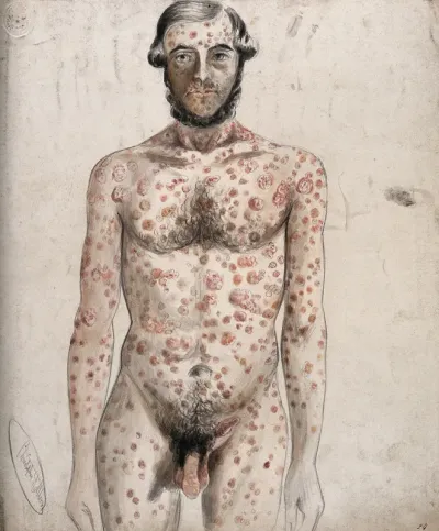 Sores and abcesses (?) covering the face and body of a man