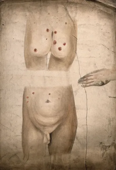 Sores and abcesses (?) on the buttocks and abdomen of a boy suffering from syphilis, with a detail showing a large boil or abcess on the boy's hand