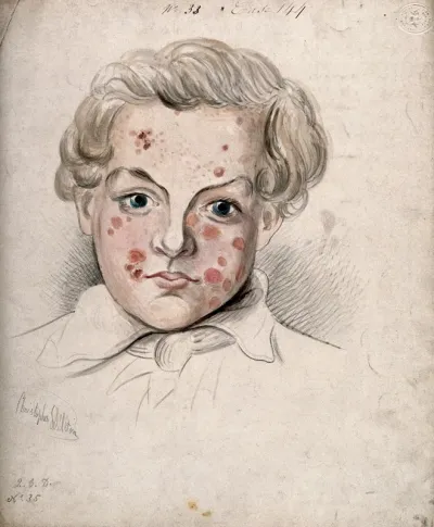 Sores and areas of diseased skin on the face of a boy