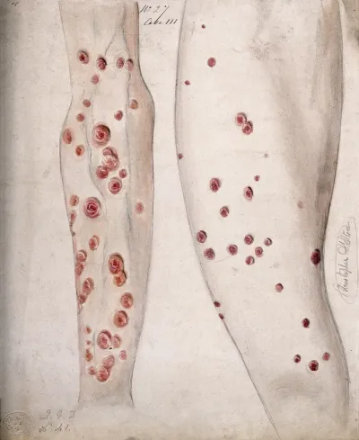 Sores and diseased skin on the arm and leg of a woman
