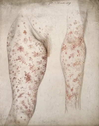 Sores and diseased skin on the leg and arm of a woman
