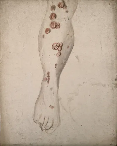 Sores and diseased skin on the leg of a woman