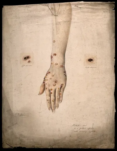 Sores and pustules on the hand and arms of a woman suffering from secondary syphilis