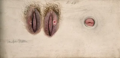Sores on the female genitalia: three details