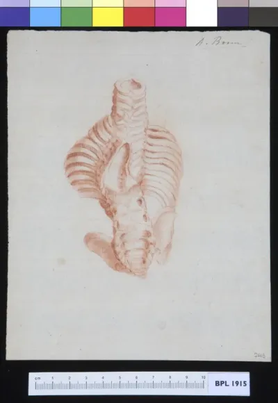 Spine with scoliosis