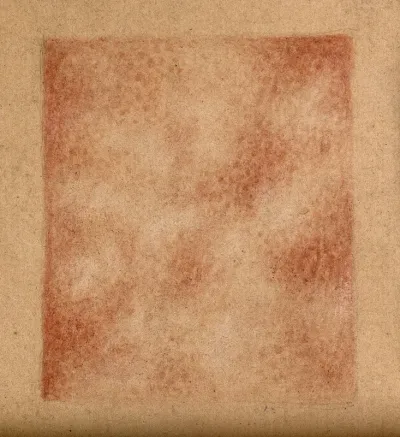 Square specimen showing a detail of the skin of a woman suffering from a rash caused by syphilis