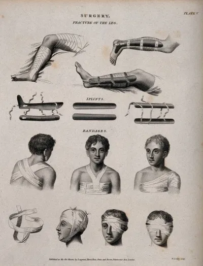 Surgery: fractured legs, splints and bandages
