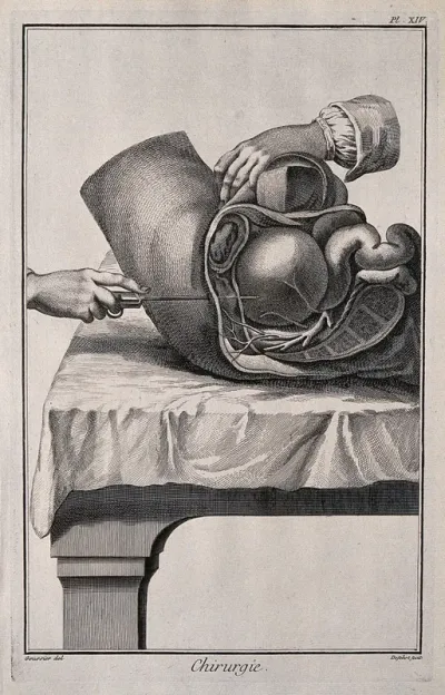 Surgery: lateral section of the hypogastrum