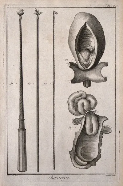Surgery: Left, surgical instruments to retrieve foreign objects from the oesophagus; right, a bladder with a bladderstone and a hernia