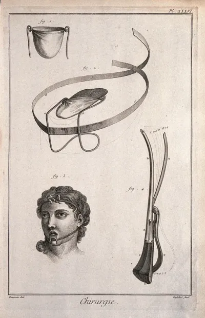 Surgery: surgical instruments, including a bandage for the tongue