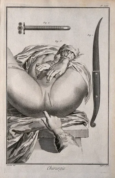 Surgery: surgical instruments including a small tube for inserting into the body to allow fluid to enter or escape (cannulla) and a surgical scalpel (bistoury) Engraving with etching by A.J