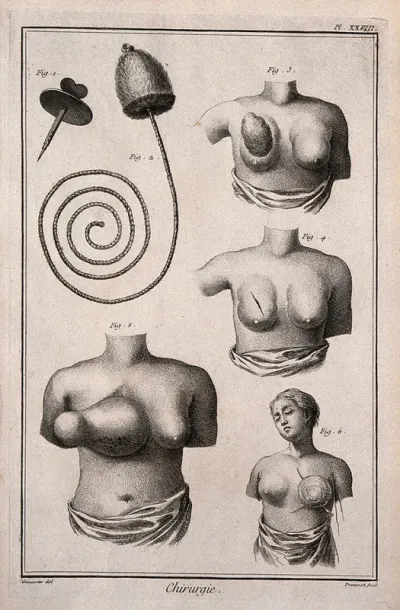Surgery, top, instruments to perform a bronchostomy; below, breasts with tumours