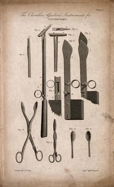 Surgical instruments: instruments for lithotomy designed by Paolo Assalini