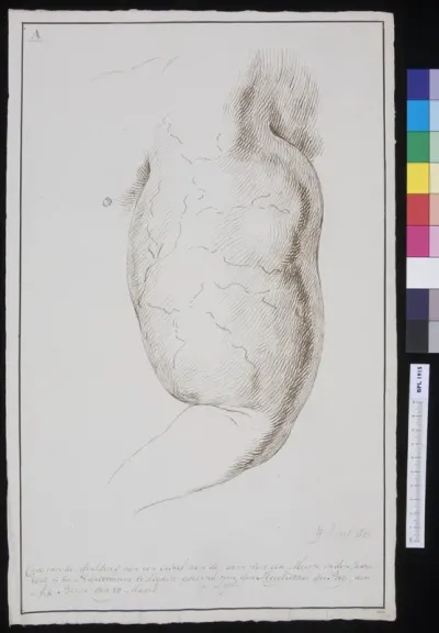 Swelling of a girl's arm