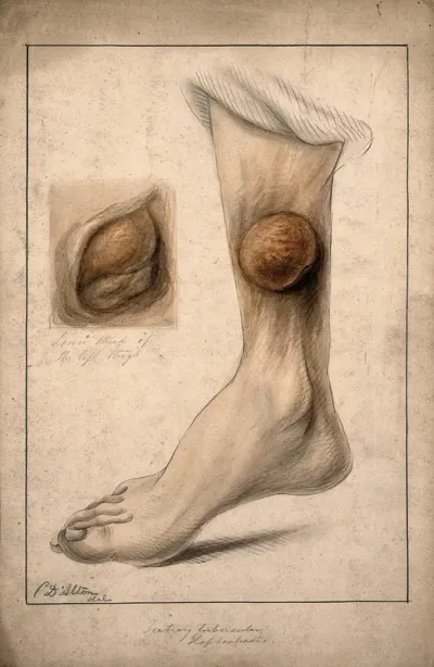 Tertiary tubercular elephantiasis on the thigh and calf of a woman