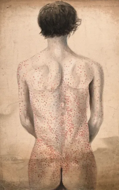 The back, arms and buttocks of a man suffering from a rash of sores