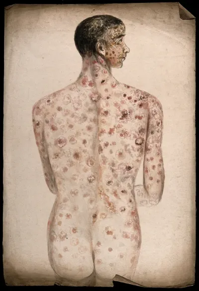 The back, arms, buttocks and face of a man suffering from diseased skin and abcesses (?) Watercolour by C