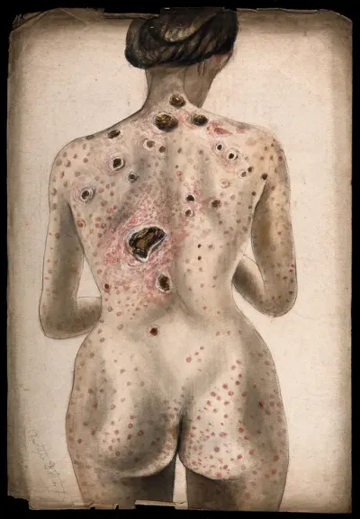 The back, buttocks and arms of a woman, displaying areas of diseased tissue and a rash of sores