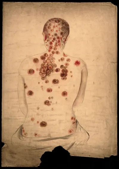 The back, neck and head of a woman, displaying areas of diseased tissue and abcesses