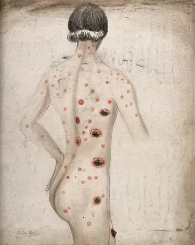 The back, neck, arms and legs of a man suffering from diseased skin and abcesses (?)