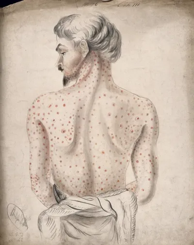 The back of a man suffering from a rash of sores