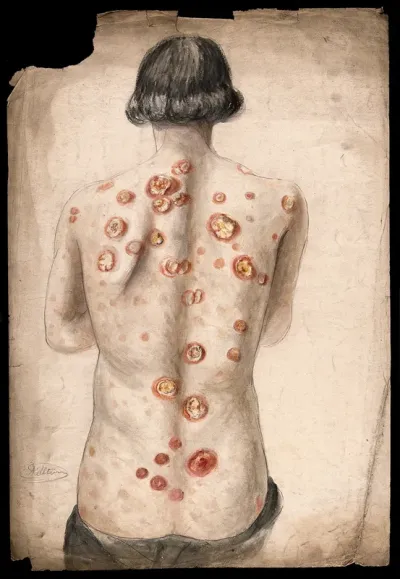 The back of a man suffering from diseased skin and abcesses (?) Watercolour by C