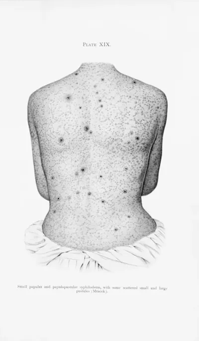 The back of a man suffering from syphilis, showing a rash of papular and papulopustular syphiloderm