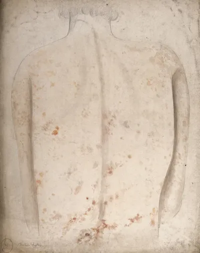 The back of a man suffering with lesions or sores