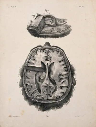 The brain: two figures of a section through a head and brain, showing the lateral ventricles and third ventricle