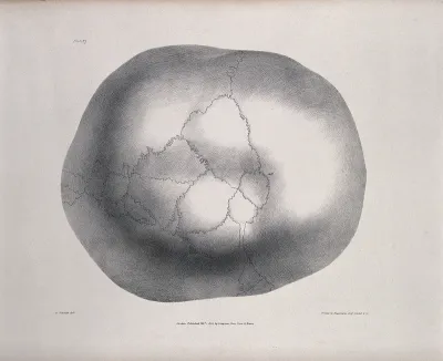 The deformed skull of James Cardinal as viewed from above