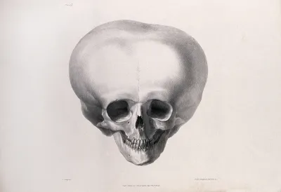 The deformed skull of James Cardinal: front view