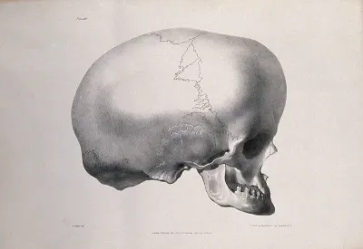 The deformed skull of James Cardinal: profile view