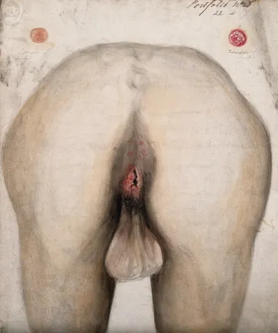 The diseased anus of a man as seen from behind; two details of sores on other parts of the body
